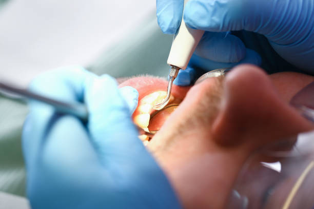 Best Emergency Tooth Extraction in Hamlin, TX